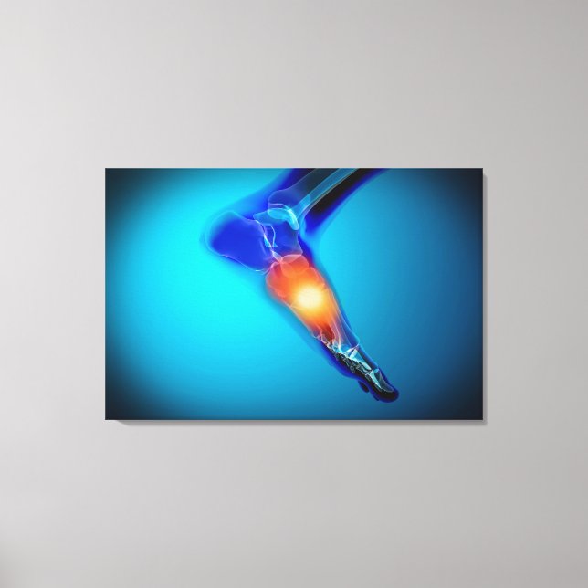Lienzo Imagen Conceptual Del Dolor En El Pie Humano (Anverso)