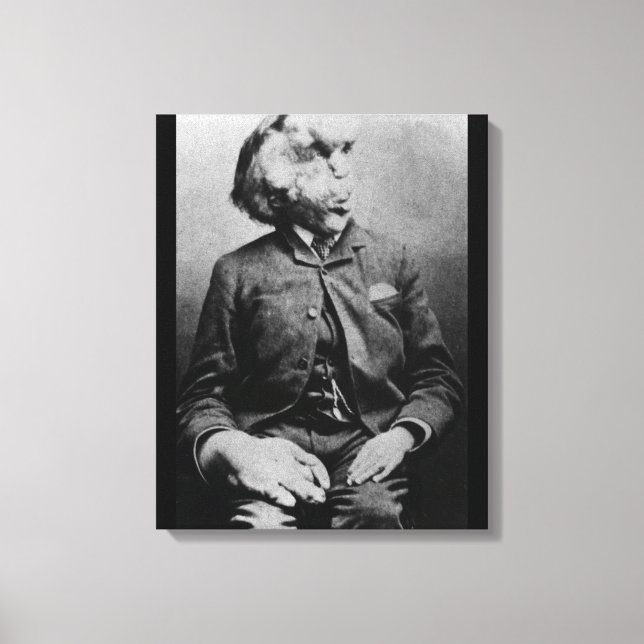 Lienzo Joseph "John" Merrick El hombre elefante de 1889 (Anverso)