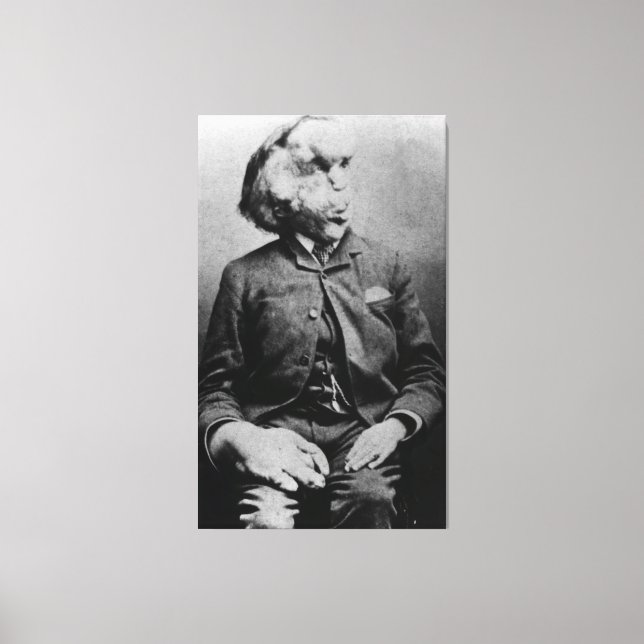 Lienzo Joseph "John" Merrick El hombre elefante de 1889 (Anverso)