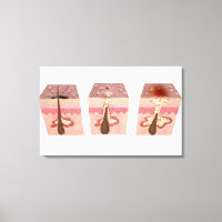 Vista de las causas del acné