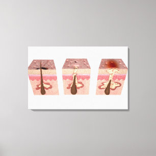 Lienzo Vista de qué causa acné