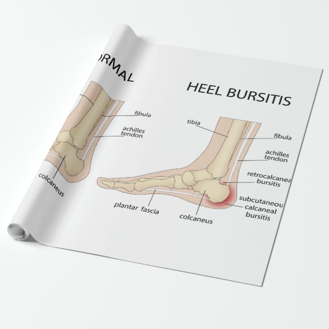 Papel De Regalo La deformidad de Haglund (Desenrollado)