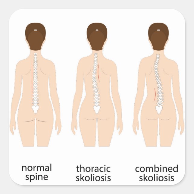 Pegatina Cuadrada Deformidad espinal (Anverso)