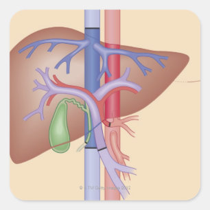 Pegatina Cuadrada Procedimiento de trasplante hepático