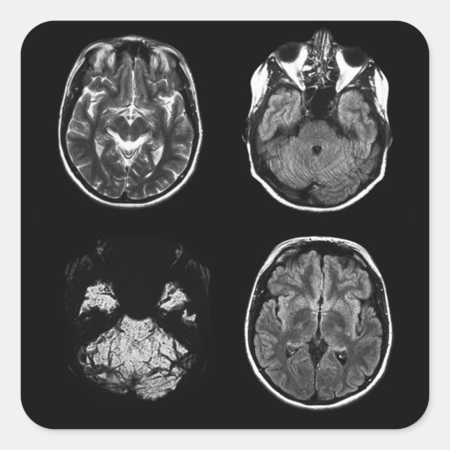 Pegatina Cuadrada Resonancia magnética cerebral (Anverso)