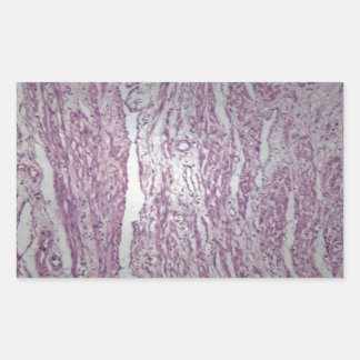 Pegatina Rectangular Células de tejido útero humano con tumor inofensiv