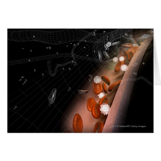 Plaque en las arterias (Anverso (Horizontal))