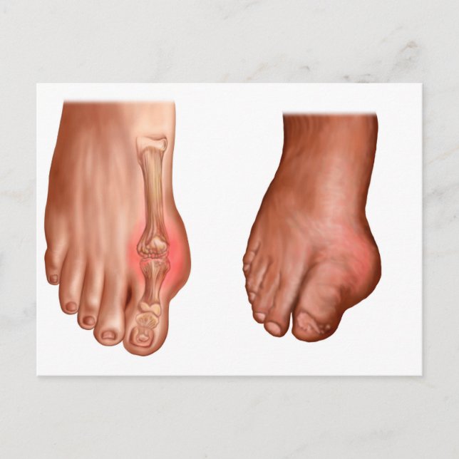 Postal Anatomía De Un Pie Hinchado (Anverso)