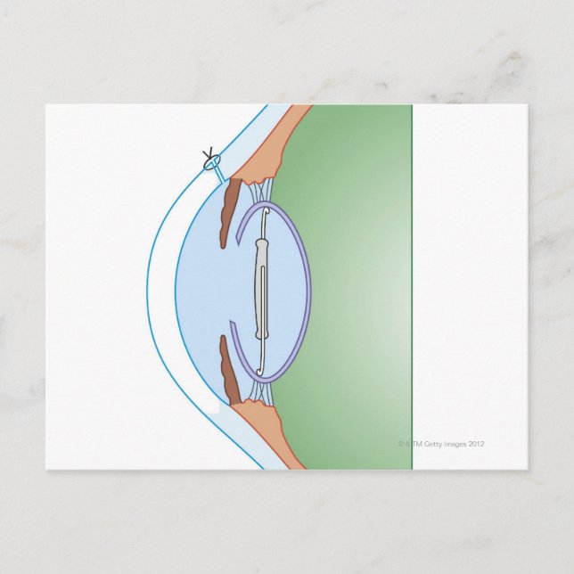 Postal Cirugía de Cataract (Anverso)