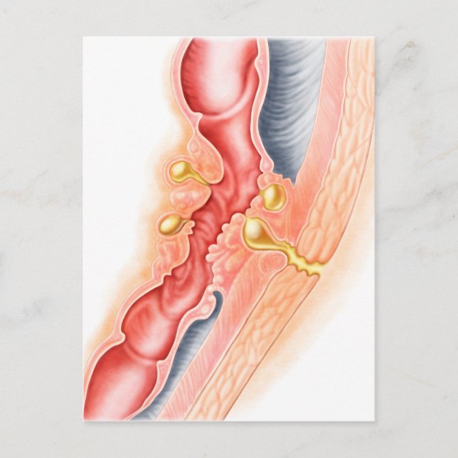 Postal Desarrollo De La Fistula (Anverso)