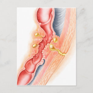 Postal Desarrollo De La Fistula