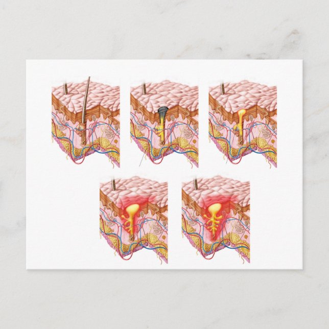 Postal Diferentes Tipos De Acné (Anverso)