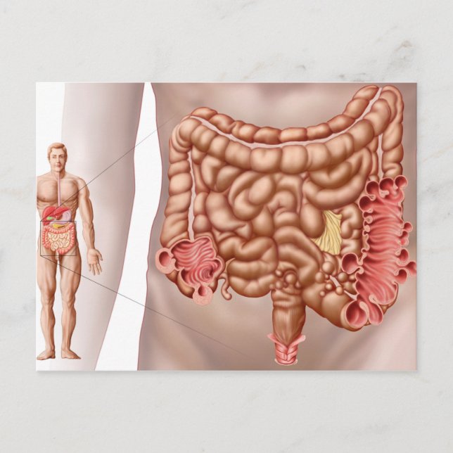 Postal Diverticulitis En La Región Colónica Descendente (Anverso)