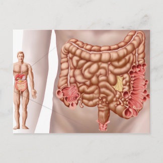 Postal Diverticulitis En La Región Colónica Descendente