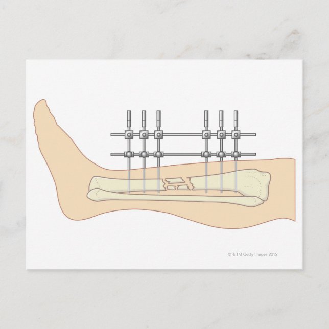 Postal Fijador externo (Anverso)
