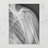 Hombro normal. Radiografía de la sana izquierda