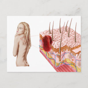 Postal Ilustracion De Un Crecimiento Atípico En La Piel
