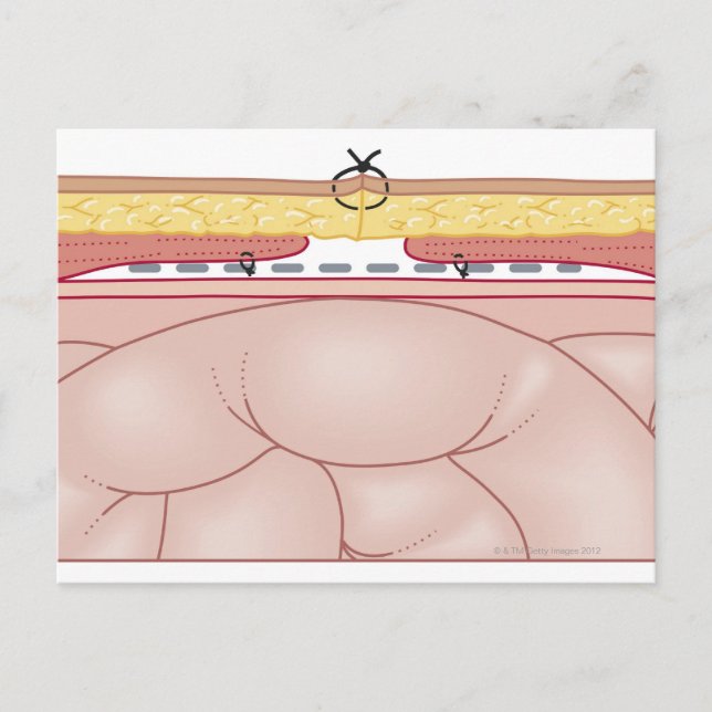 Postal Ilustracion de una Hernia (Anverso)