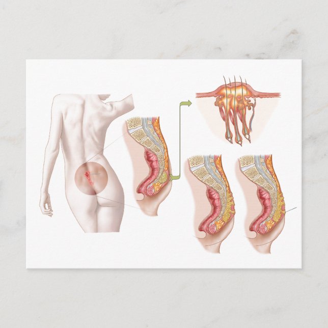 Postal Ilustración Médica De Un Ciclo Pilonidal (Anverso)