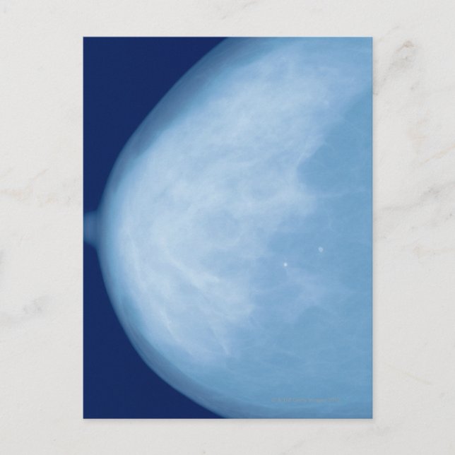 Postal Rayos X de la mama femenina, vista lateral (Anverso)