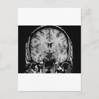Postal Resonancia magnética cerebral, trozo coronal