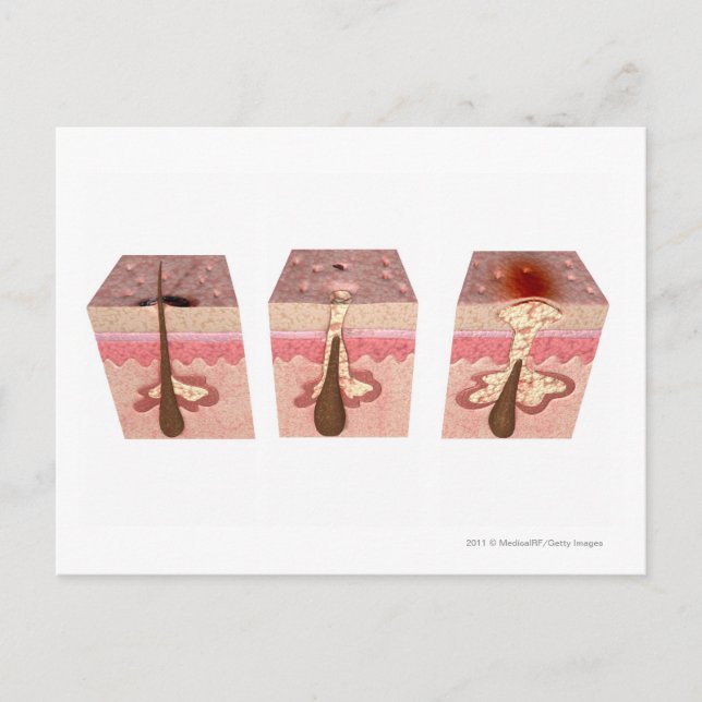 Postal Vista de las causas del acné (Anverso)