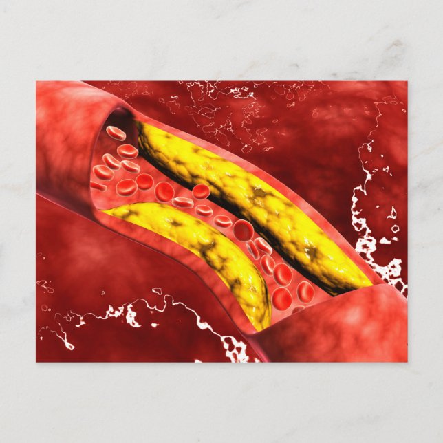 Postal Vista Microscópica De La Placa Grasa Dentro De La  (Anverso)