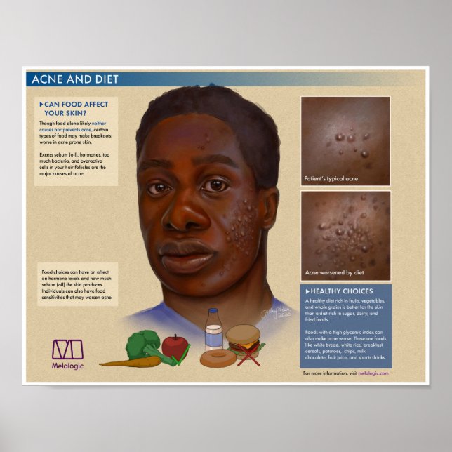 Póster Acné melalógico y Poster médico dietético (Frente)
