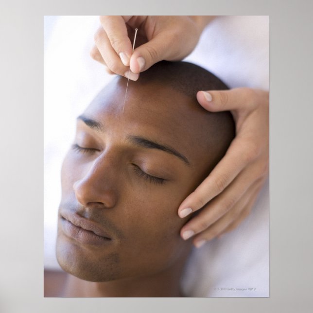 Póster Acupuntura. Acupunturista insertando una aguja (Frente)