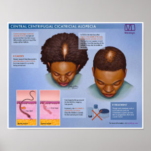 Póster Alopecia Cicatrial Centrocentrifugana Melalógica