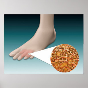 Póster Anatomía De Hongos De Pie Con Cierre Microscópico