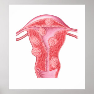 Póster Anatomía de tumores fibroides en útero femenino