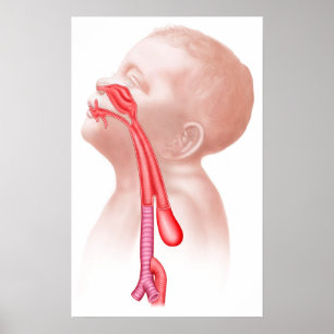 Póster Anatomía de una fístula traqueoesofágica