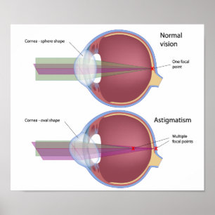 Póster Astigmatismo, un Poster frecuente de defectos ocul