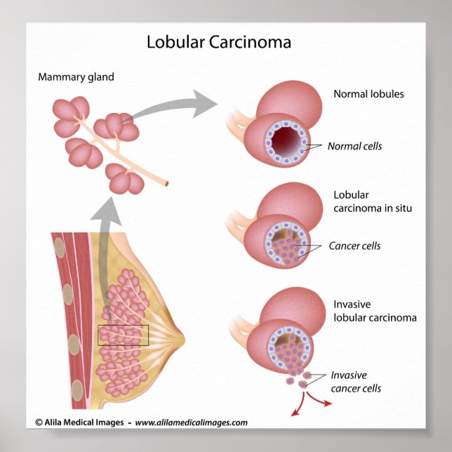 Póster Cáncer de mama lobular, diagrama marcado. (Frente)