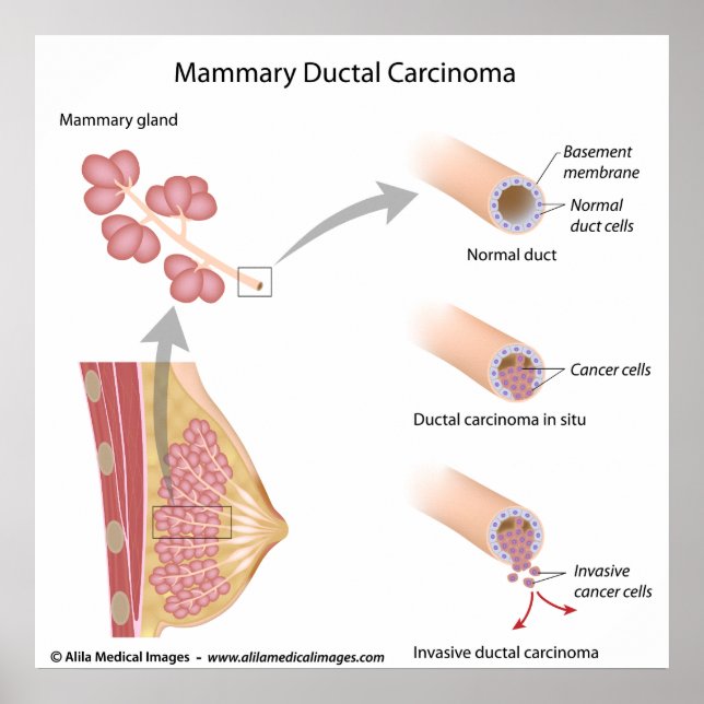 Póster Carcinoma ductal de cáncer de mama, diagrama marca (Frente)