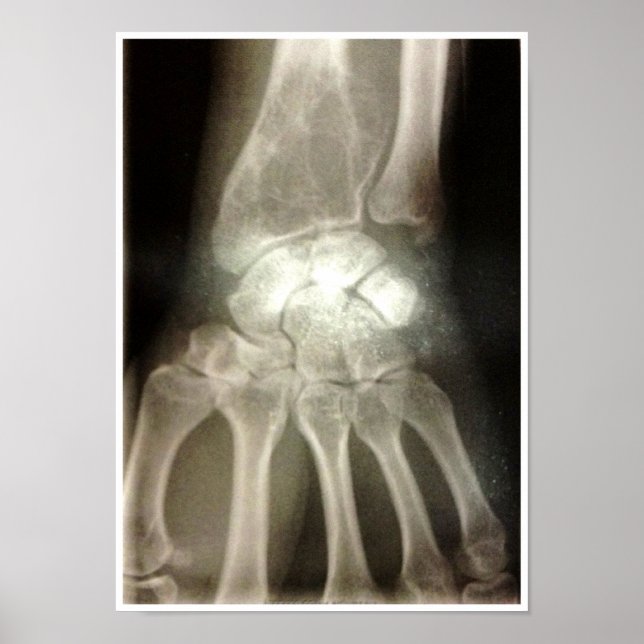 Póster Carpals Xray Poster (Frente)