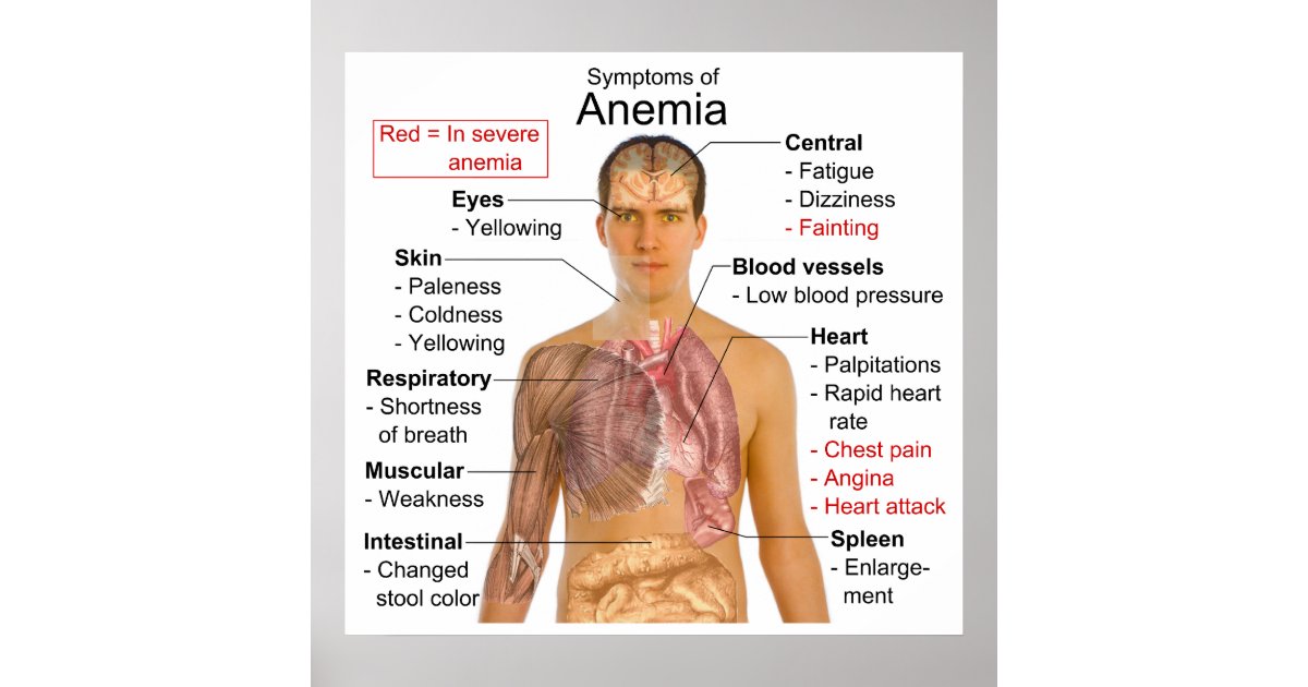 Póster Carta de los síntomas de la anemia de la | Zazzle.es