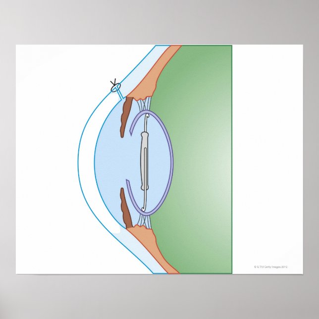 Póster Cataract Surgery (Frente)