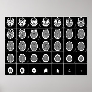 PÓSTER CT SCAN DE CABEZA