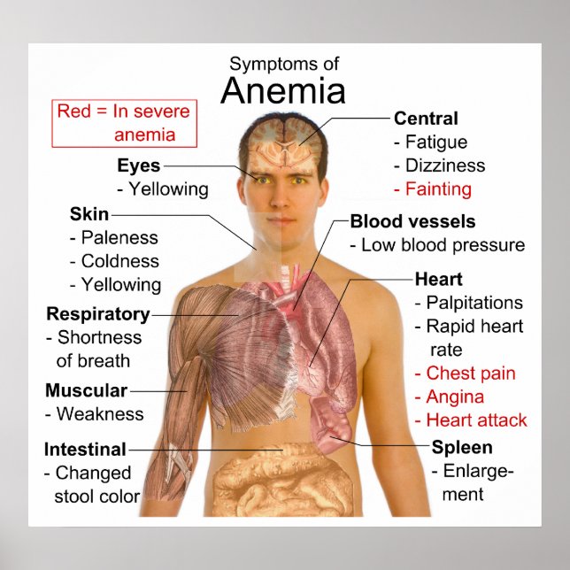 Póster Cuadro de síntomas de la anemia por enfermedad de  (Frente)