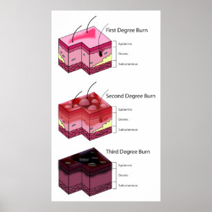 Póster De la piel de la quemadura del segundo primero