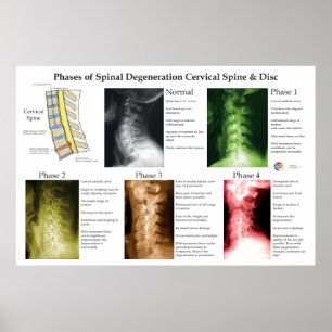 Póster Degeneración Espinal Columna Cervical Quiropráctic