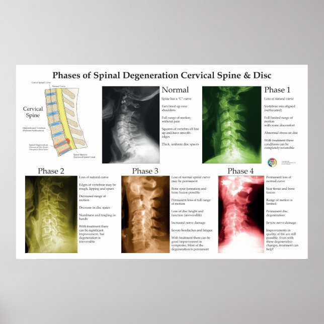 Póster Degeneración Espinal Columna Cervical Quiropráctic (Frente)