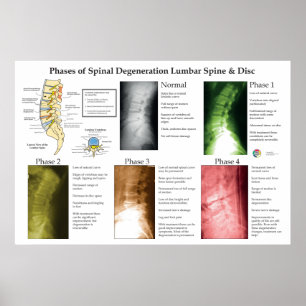 Póster Degeneración Espinal Columna Lumbar Quiropráctica