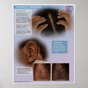 Póster Dermatitis Seborreica Melalógica (Dandruff) Médico