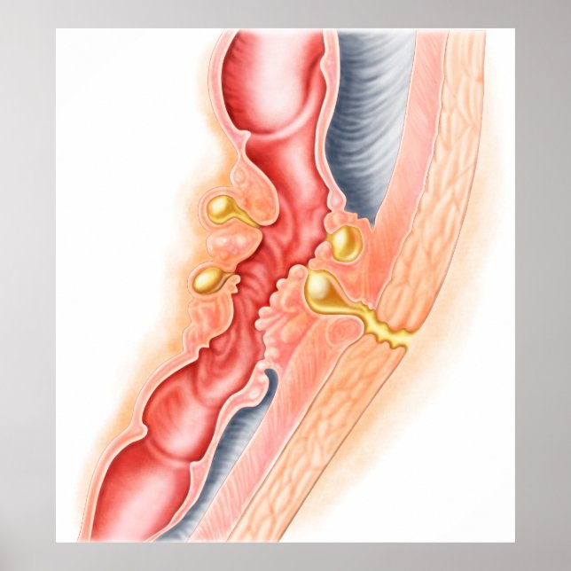 Póster Desarrollo De La Fistula (Frente)