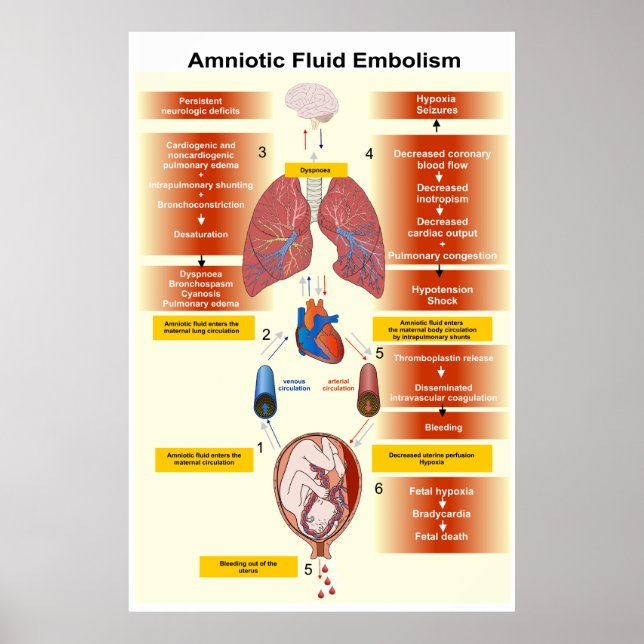 Póster Diagram of an Amniotic Fluid Embolism AFE (Frente)
