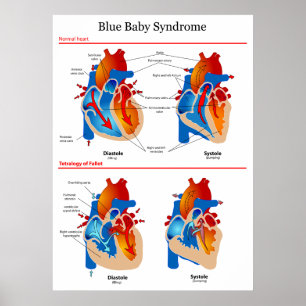 Póster Diagrama anatómico del corazón del síndrome del