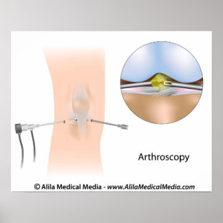 Póster Diagrama de artroscopía de rodilla.